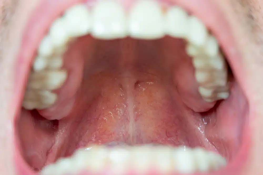 Understanding Swelling of the Roof of the Mouth