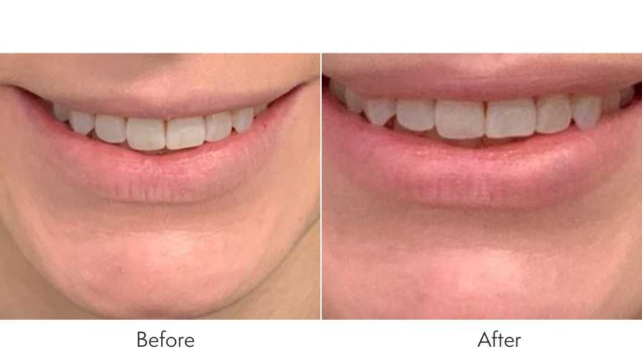 Best 7 Lip Flip Before and After Results 7 Lip Flip Before and After