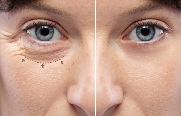 eye lift